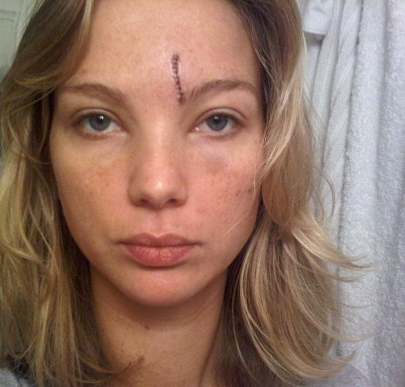 World Renowned Model Sustains Permanent Facial Scars From Horrific Taxi Cra...