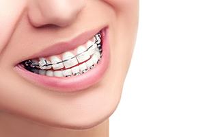 Braces Mouth