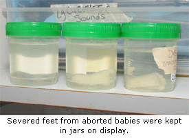 Jar of severed feet at Gosnell's abortion clinic